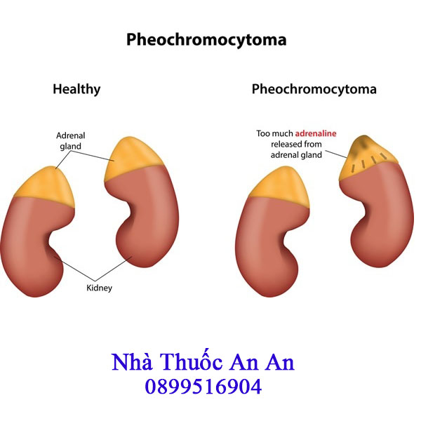 Phương pháp chẩn đoán Pheochromocytoma và Paraganglioma