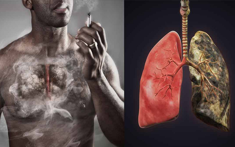 Dấu hiệu ung thư phổi ở nam giới và nữ giới